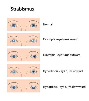 strabismus